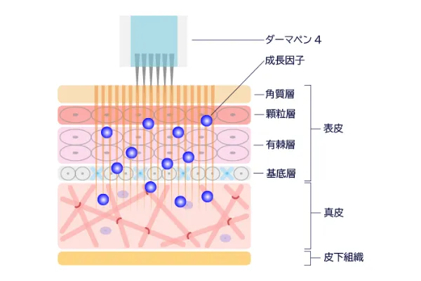 ヴァンパイアフェイシャル施術イメージ
